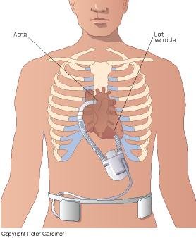 LVAD