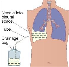 Pleural Tap